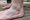 Ganglion Cyst