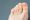 A young woman has hard corns and calluses on her toes from wearing shoes that uncomfortable and don