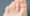 A young woman has hard corns and calluses on her toes from wearing shoes that uncomfortable and don